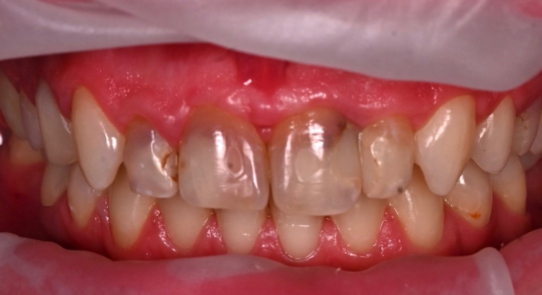 Caz fațete dentare Bel-Dent Baia Mare, discromii dentare înainte de tratament