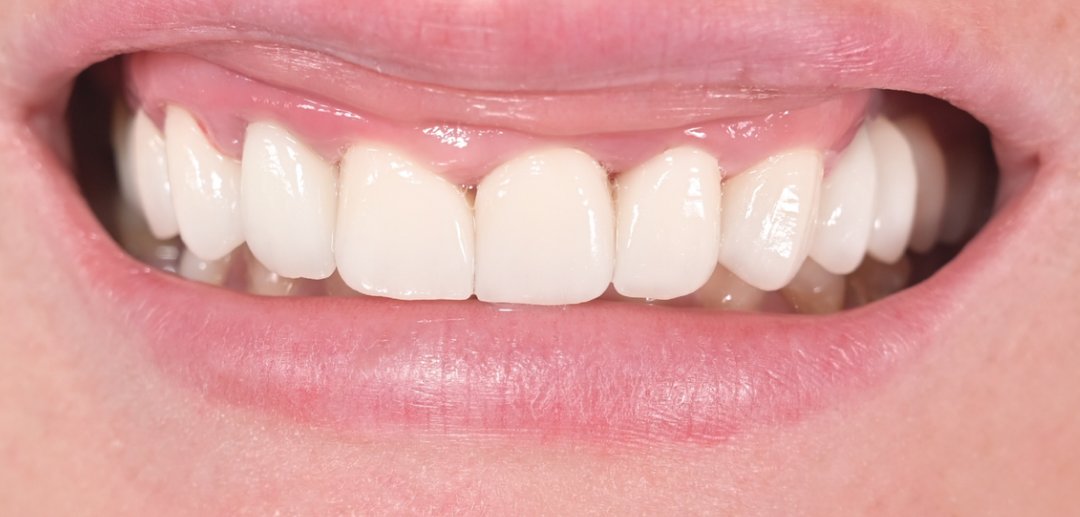 Caz reabilitare protetică Bel-Dent Baia Mare, zâmbet natural după tratament