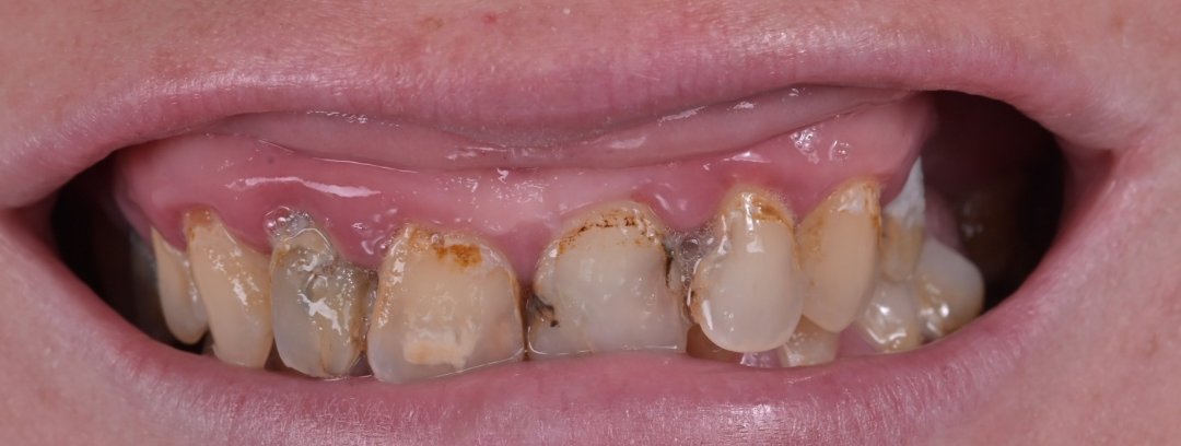 Caz reabilitare protetică Bel-Dent Baia Mare, dinți frontali afectați înainte de tratament