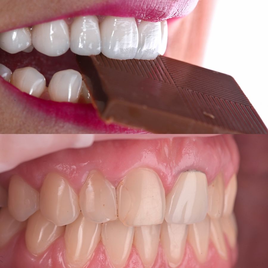 Probă a unei coroane dentare, comparație culoare, Bel-Dent Baia Mare