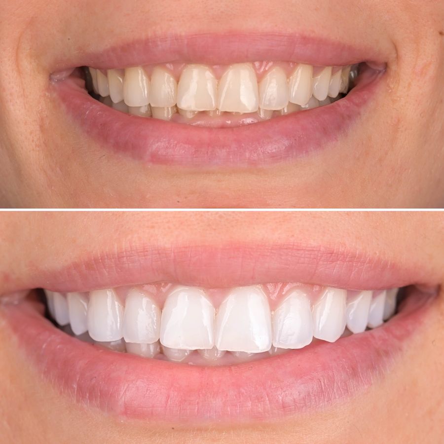Exemplu de rezultat dentar din portofoliul Bel-Dent Baia Mare